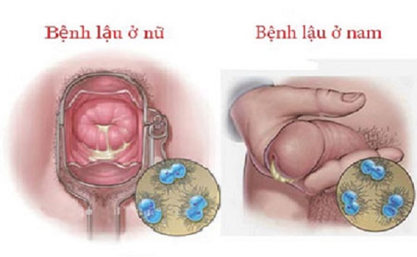 Triệu chứng thường thấy nhất ở bệnh lậu là chảy dịch bất thường ở âm đạo, hậu môn hay dương vật