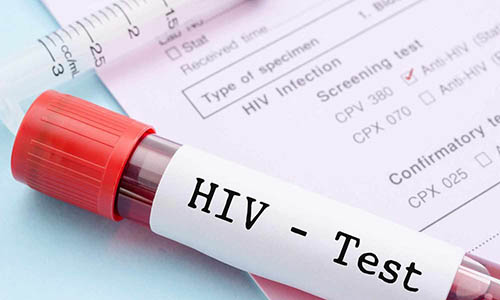 Xét nghiệm sau khi quan hệ với người nhiễm HIV