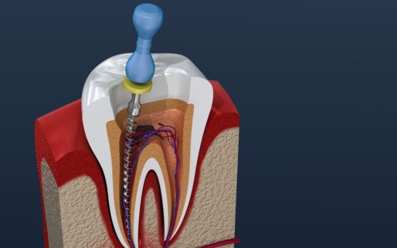 Điều trị tủy nếu lỗ sâu lan xuống tủy